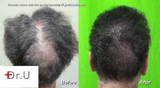 Before and After Hair Restoration Repair for Past Hair Surgeries Using UGraft - Crown slot deformity from scalp reduction Before and After Hair Restoration Repair for Past Hair Surgeries Using UGraft - Crown slot deformity from scalp reduction