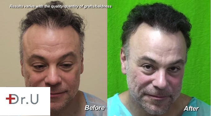 Full View of the Face| Patient After His Hair Transplant Repair