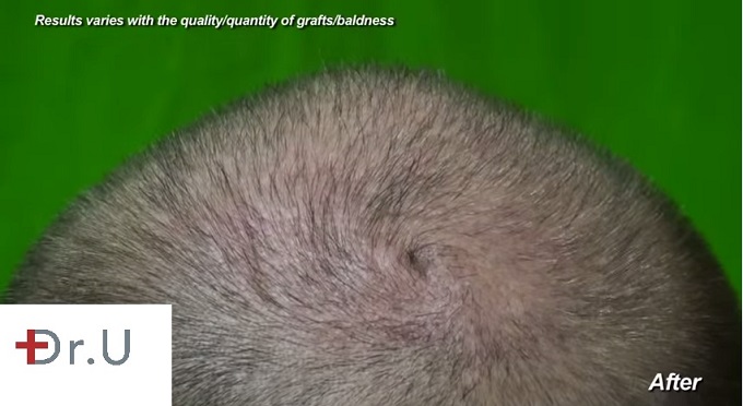 Photo of Patient's Crown Whorl| Results After FUE Hair Transplant Surgery