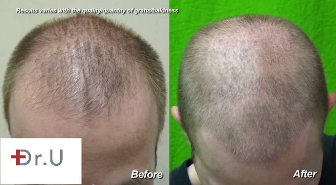 Frontal Scalp, Before & After FUE Hair Restoration Using 3000 grafts