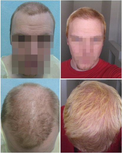 Hair Transplant Cost| Repair Surgeries