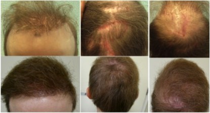 hair transplant cost|bht surgery|hair transplant repair hair transplant cost|bht surgery|hair transplant repair