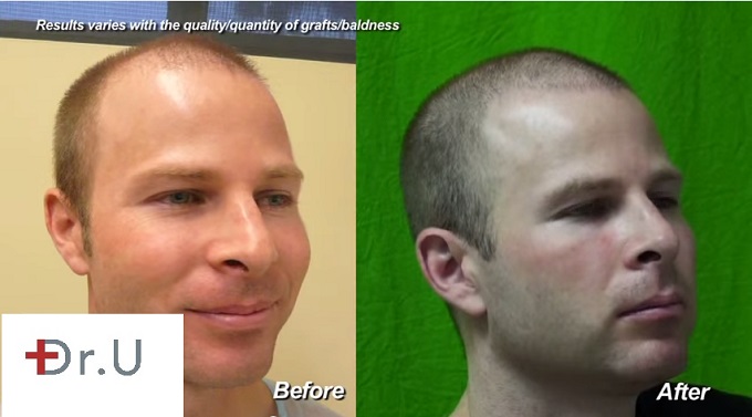 Patient's Hairline & Temples| Before and After 3000 Graft FUE Surgery