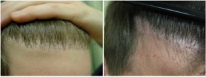 Trivia: All About Hair Transplantation, find out what you know