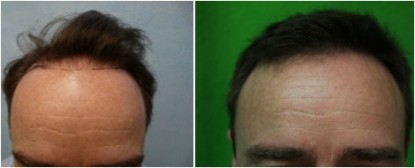 UGraft Nape Hair FUE Hair Transplant