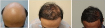 FUE hair transplant result using beard hair for severely bald patient.
