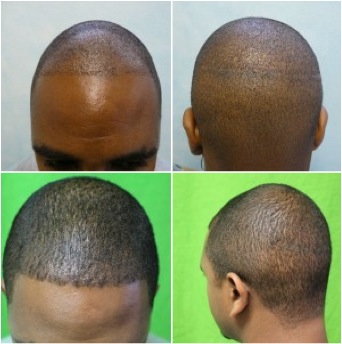 FUE hair transplant on African American patient.