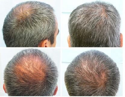 Thinning Crown| Crown Hair Loss| Beard Hair Grafts