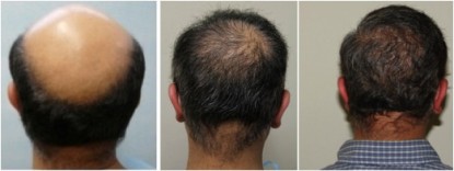 Hair transplant for Norwood 7 baldness. 