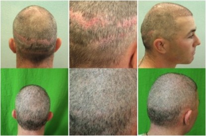 hair transplant repair photo| multiple strip surgeries|camouflaging strip scar