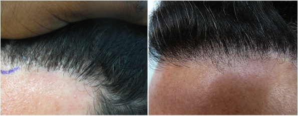hair transplant photos| natural looking hairline|closeup view of edge