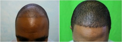 hair transplant photos, real patient before and after