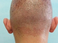 Hair transplant results includes wound healing outcomes. Hair transplant results| wound & donor healing