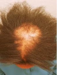 African American FUE Hair Transplant |Central Cicatrical Centrifugal Alopecia