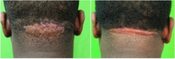 African American FUE hair transplant|scarring risks