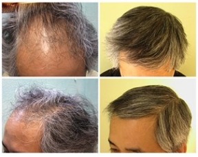 Asian FUE Hair Transplant - DermHair Clinic LA 1-310-318-1500 Asian FUE Hair Transplant - DermHair Clinic LA 1-310-318-1500