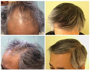 Ethnic Hair Loss 82