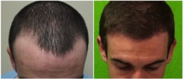 FUE hairline transplant results|natural looking hairline FUE hairline transplant results|depleted temples|patient photos -before&after