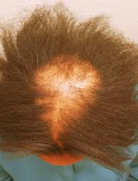 female hair loss|black women|Central Cicatricial Centrifugal Alopecia female hair loss|black women|harsh chemicals