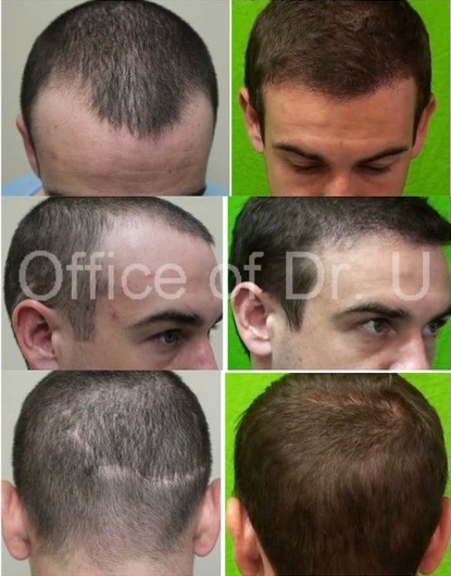 uGraft FUE Hair Transplant using 1500 Grafts, FUE Results of Young Patient Hairline and Strip Scar Repair. uGraft FUE Hair Transplant using 1500 Grafts