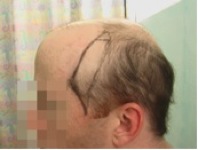 Should severely bald men wear a hairpiece?