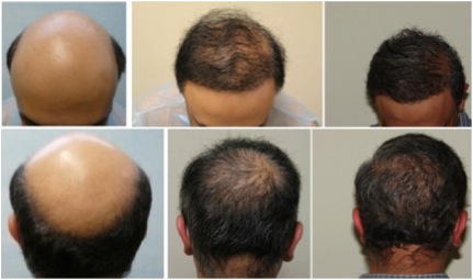 Severely bald patient chooses a body hair transplant surgery over wearing a hairpiece