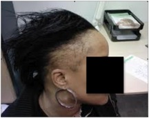 traction alopecia|hair loss|sides of scalp Traction Alopecia|sides of head|female