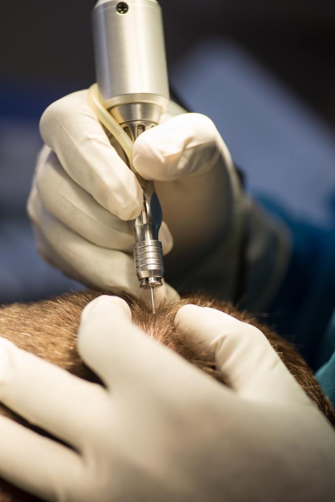 best fue hair transplant tool for advanced FUE