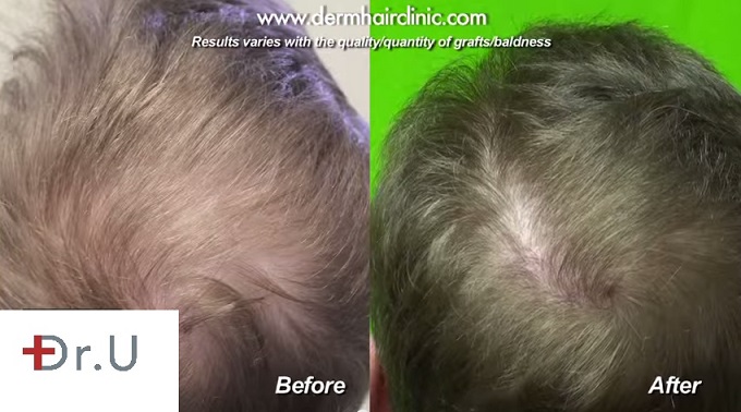 Improved Crown Coverage with FUE Hair Transplant Using 2300 Grafts