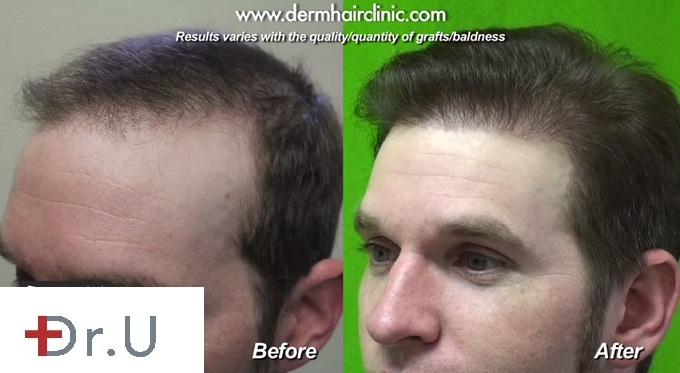 Hairline and Temple Advancement| FUE Results on Male Patient