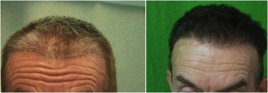 Repair of botched hair transplant| best FUE hair transplant surgeon| Advanced FUE|body hair Repair of botched hair transplant| best FUE hair transplant surgeon| Advanced FUE|body hair