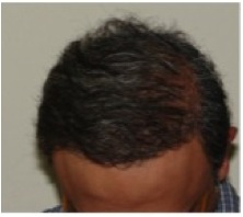 After BHT on NW | successful hair restoration for severely bald patient