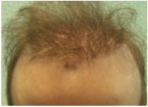 Before BHT repair| hair graft placement