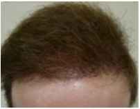 Results of BHT repair|normal coverage