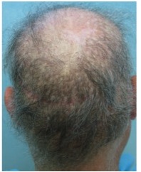 Before repair using BHT| botched hair restoration