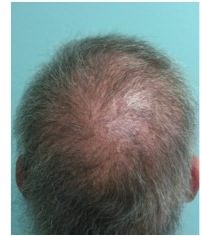 After repair using BHT| body hair grafts| concealing scars