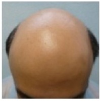 Before BHT on NW | body hair transplant clinic