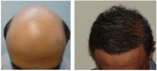 hair loss info | reversing Norwood 7 baldness Hair Loss Info | Treating Severe Baldness