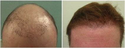 hair loss info | FUE hairline restoration Hair Loss Info | hairline creation through FUE