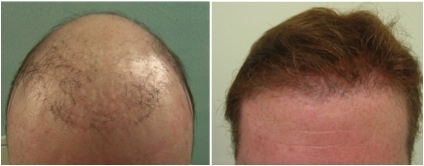 Hair Loss Info | hairline creation through FUE