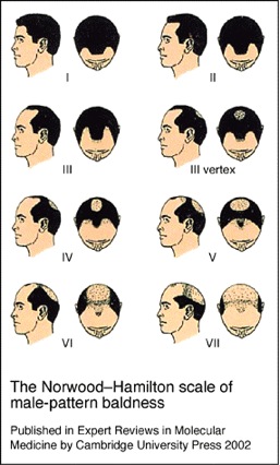 hair loss info|the stages of male pattern baldness Hair Loss Info|male pattern baldness stages|Hamilton Norwood