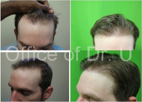 FUE Hair Transplant Using 2300 Grafts hairline, temple and crown before and after