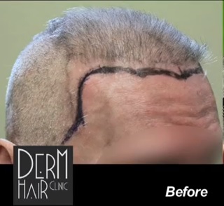 Body hair transplant patient successfully repairs multiple botched surgery results
