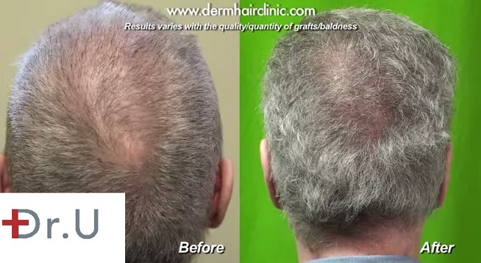 Improved Crown Coverage| Before and After Beard Hair Transplant Repair using 6500