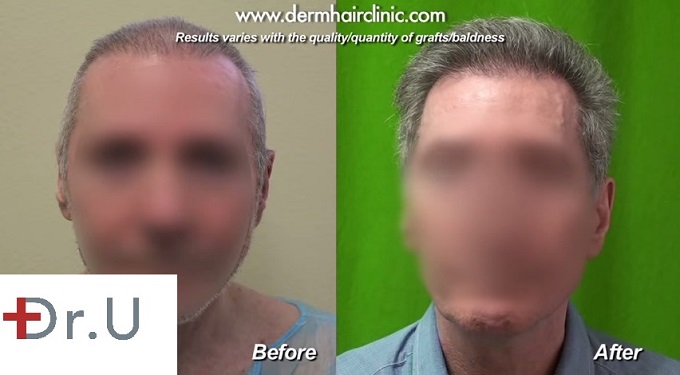 Full Face View of Patient's Final Results| Repair With Beard Hair Grafts