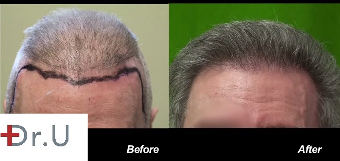 Front View|before and after Beard Hair Transplant Repair using 6500