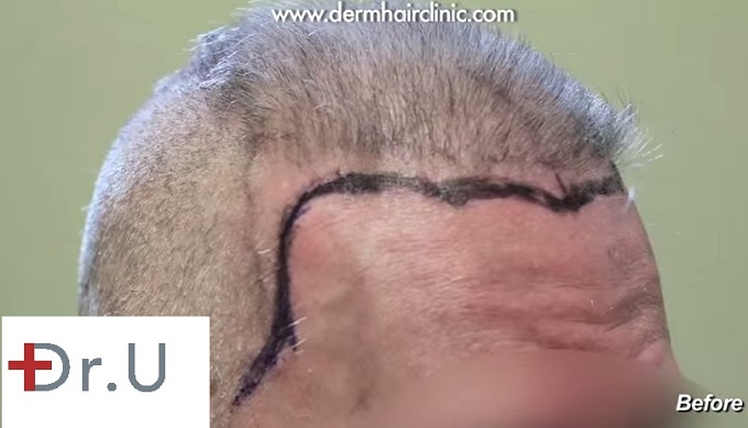 Pluggy Hair Grafts| Planning New Hairline before beard hair transplant repair using 6500 grafts