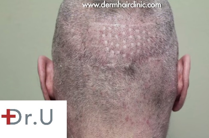 Punch Graft Scars created by 4mm punches extractions developed by Orentreich in the 1950s Punch Graft Scars created by 4mm punches extractions developed by Orentreich in the 1950s