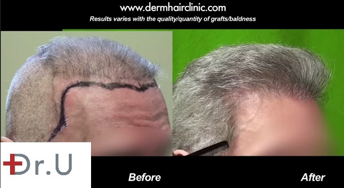 BHT Patient's New Temple Points|Profile View, before and after beard hair transplant repair using 6500 grafts