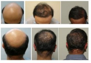 ACELL does NOT grow hair and does not help hair growth. Body hair transplant without ACELL works well in the hands of Dr U.